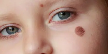 Birthmark Removal