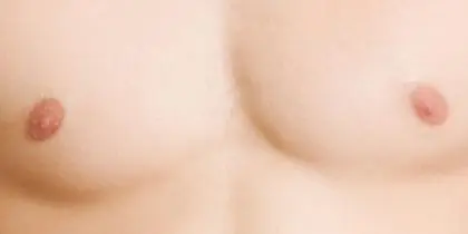Gynaecomastia