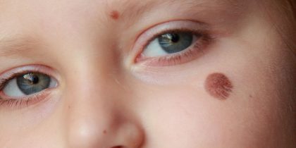 Birthmark Removal