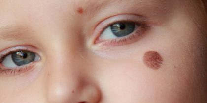 Birthmark Removal